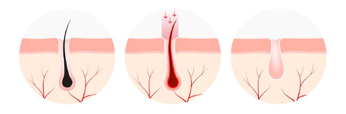&eacute;pilation au laser - technique