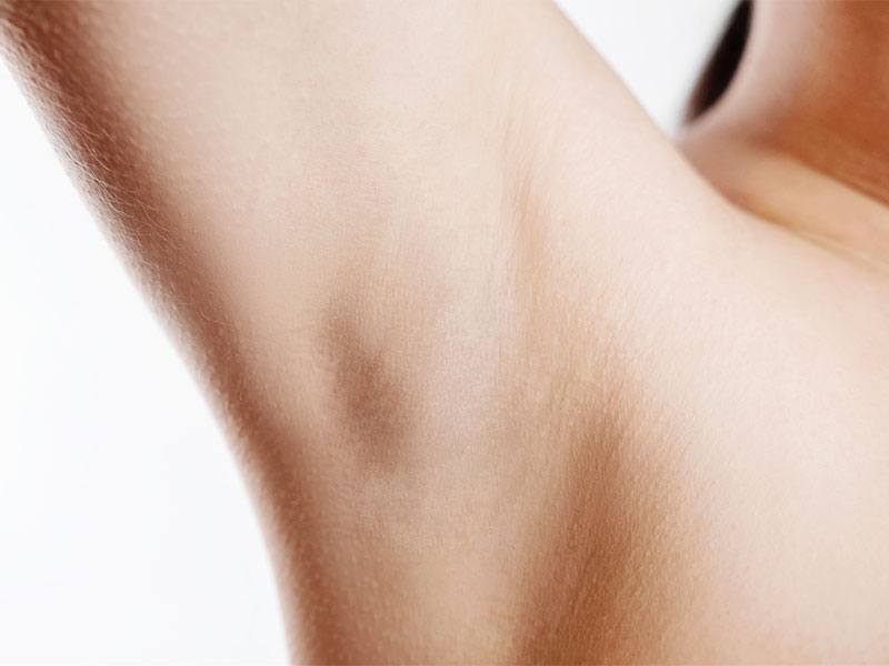 aisselles après - my laser