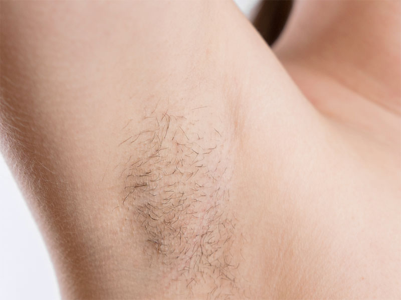 aisselles avant - my laser