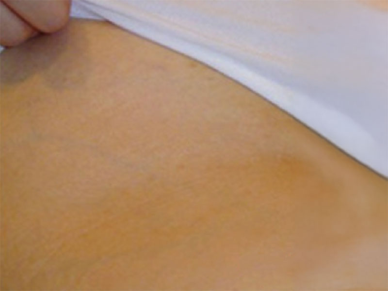 bikini après - my laser