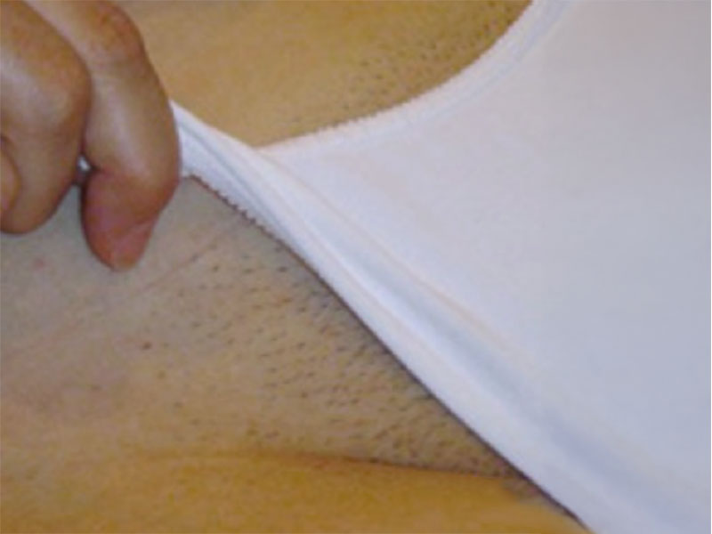 bikini avant - my laser