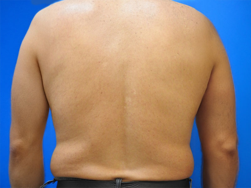 dos après - my laser