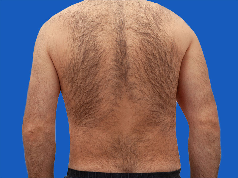 dos avant - my laser