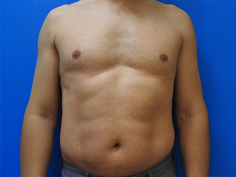 torse après - my laser