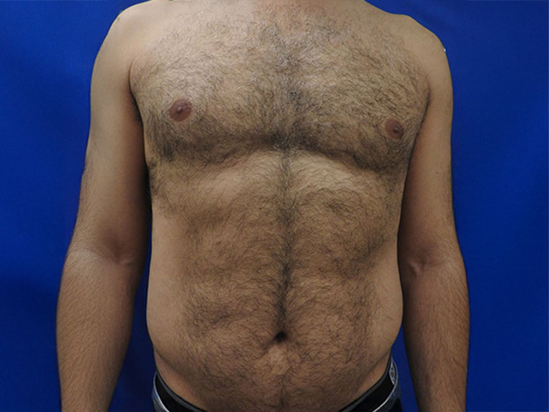 torse avant - my laser