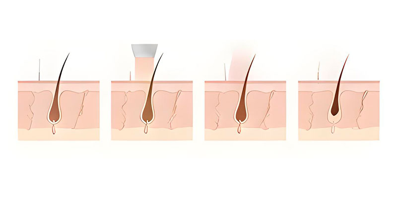 fonctionnement laser épilation lausanne