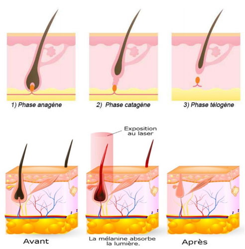 cycle pilaire - épilation laser définitve