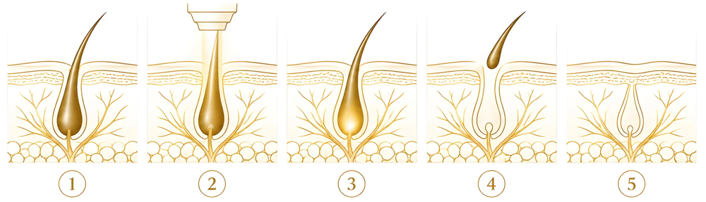 comment fonctionne le laser - my laser lausanne