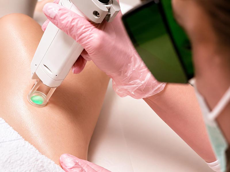 Epilation laser médicale lausanne